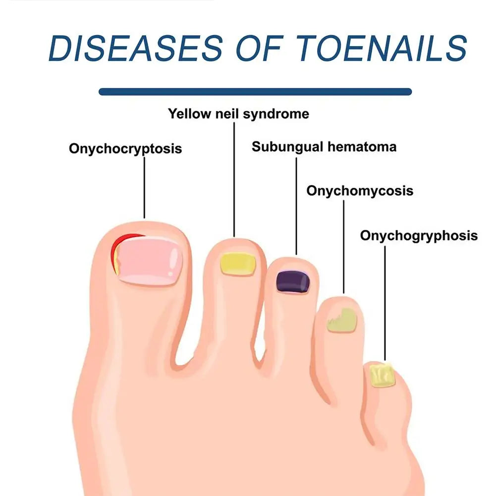 Nail Care Device for Fungal Treatment & Ingrown Nail Relief