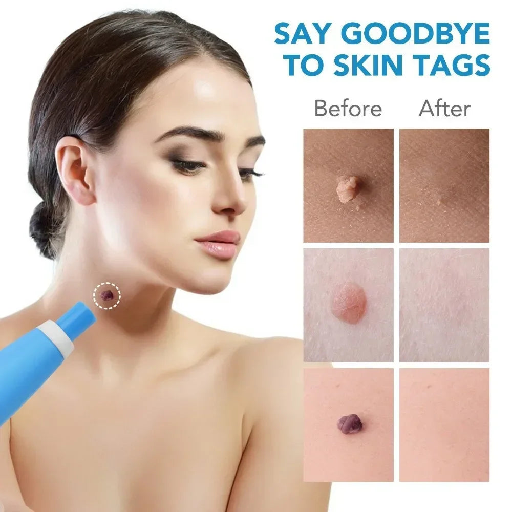 2-in-1 Painless Skin Tag & Mole Removal Kit